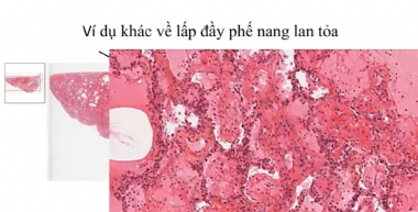 Xét nghiệm tế bào học trong bệnh lý màng phổi: lợi ích và hạn chế