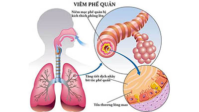 ❎❎ NHỮNG SAI LẦM TRONG ĐIỀU TRỊ NHIỄM TRÙNG HÔ HẤP ❎❎